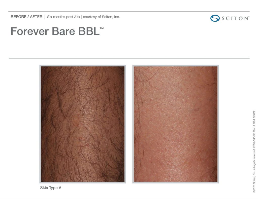 Laser Hair Removal Legs