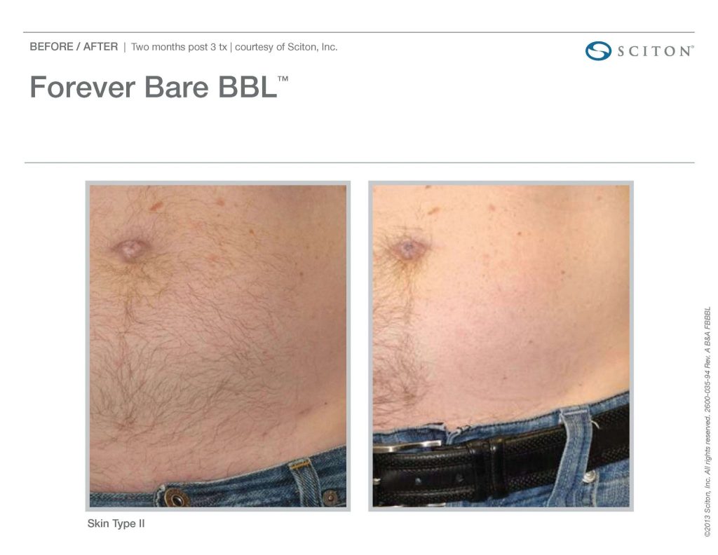 Laser Hair Removal Tummy