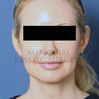 Chin Liposuction After