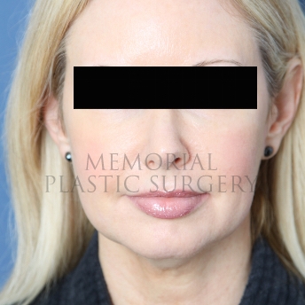 Chin Liposuction before