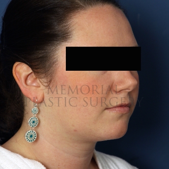 Chin Liposuction After