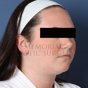 Chin Liposuction before