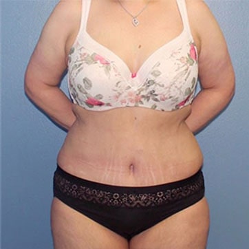 tummy tuck front view after