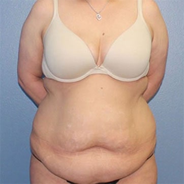 Tummy tuck front view before