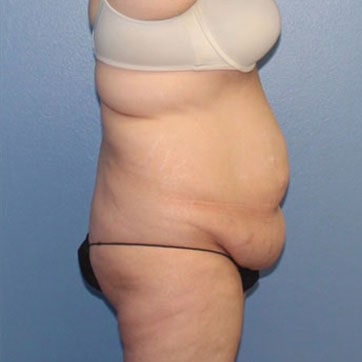 tummy tuck side view before