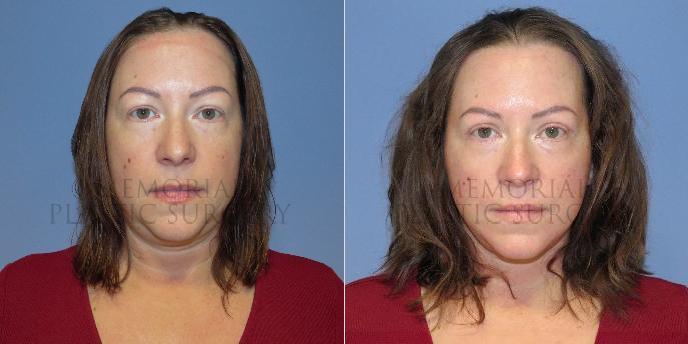 Blepharoplasty Before and After