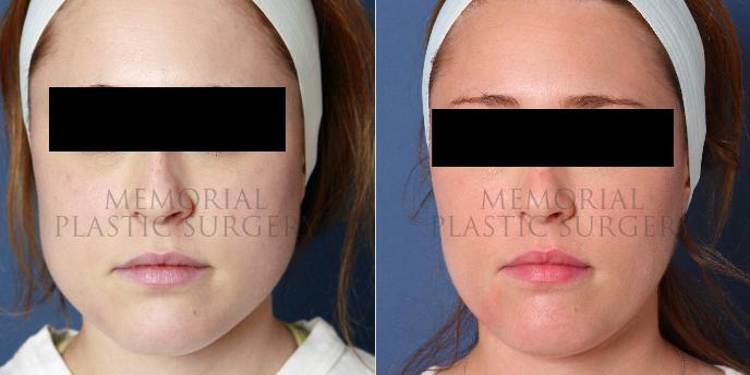 Buccal Fat Removal Before and After