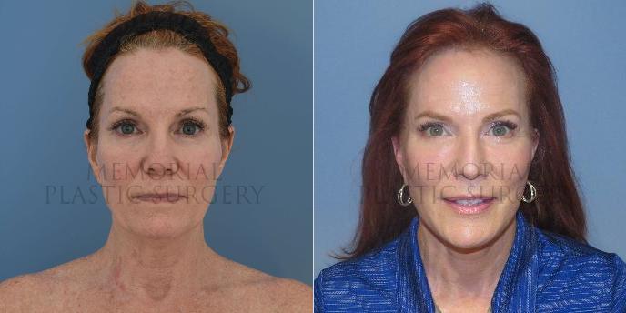 Facelift Before and After