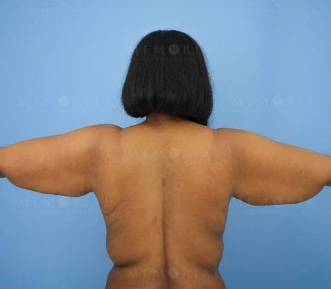 Arm Lift Before