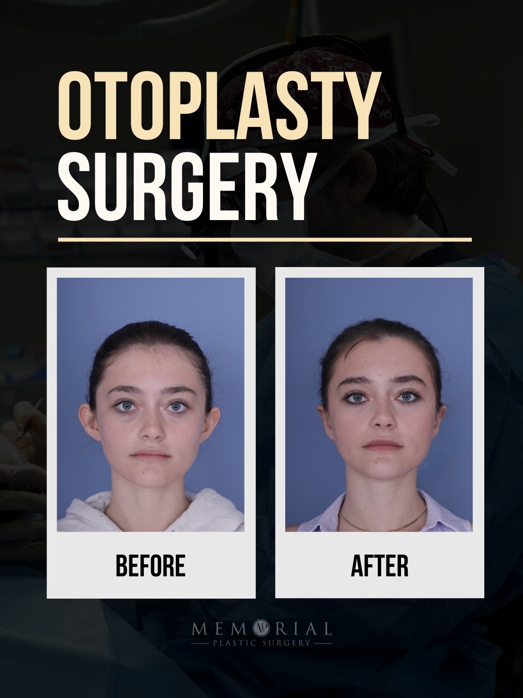 Otoplasty 👂🏻
This young lovely patient grew up always bothered by her ears sticking out. She felt she couldn’t wear hats, headbands, or certain hairstyles because she was worried about how her ears would show.
In this case, we refined the projection of the ears and reshaped the cartilage to create a more natural contour that sits closer to the head — without looking overcorrected.
Now her entire face looks more balanced and she can wear whatever she wants and her hair however she wants without worrying 👌🏻
📍 @memorialplasticsurgery | #Houston