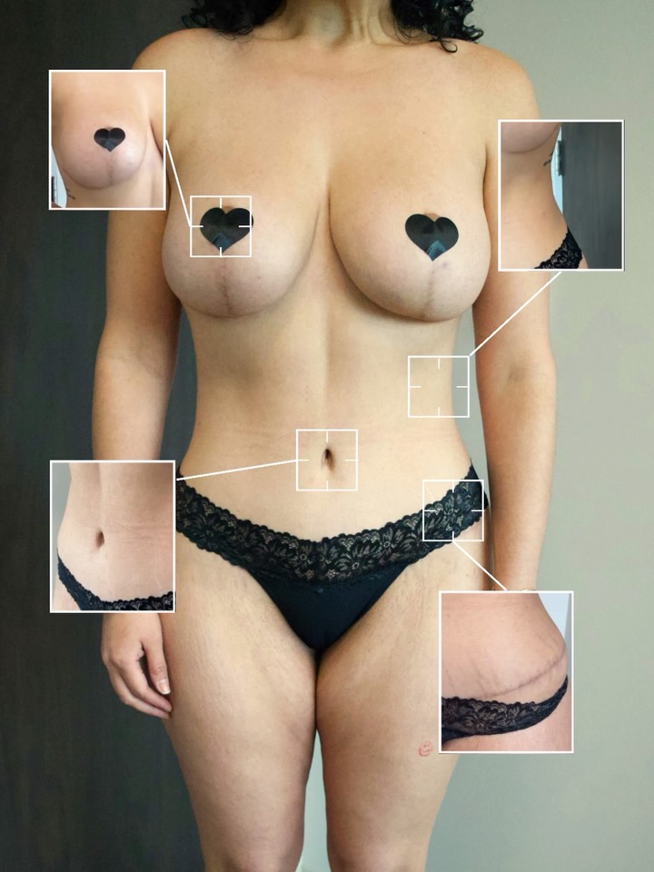 The real transformation is in the details 👌🏼
The shape of the waist.
The position of the belly button.
The quality of the scar.
The balance of the breasts.
True body contouring is about harmony 👆🏼
That’s what makes the difference #BODYBYHSU
📍 @memorialplasticsurgery | #Houston