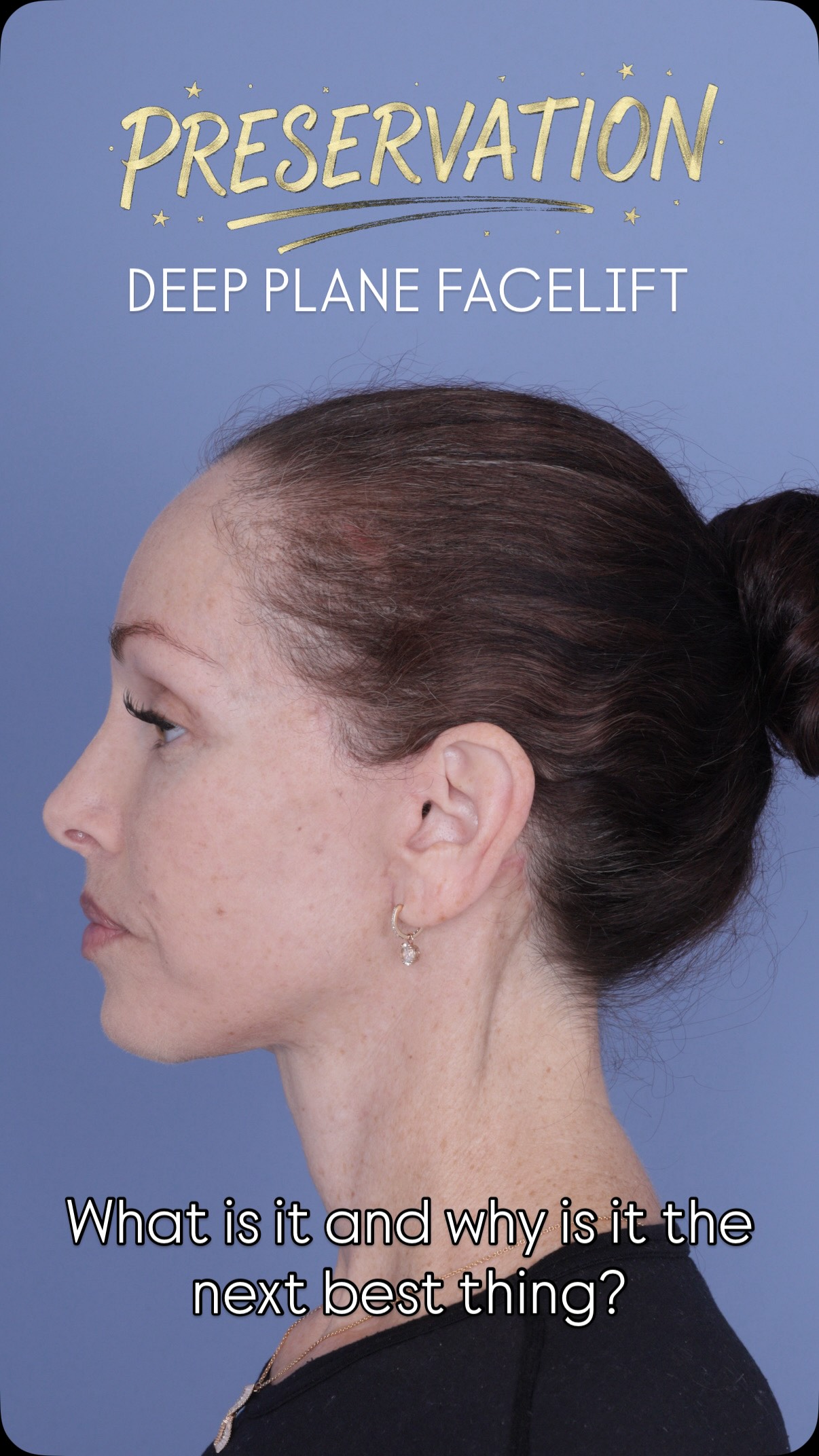 What even is a preservation deep plane facelift?
We surgeons like to just add words to procedures and sometimes I think this just confuses patients. What are we preserving? Why is everything in plastic surgery getting the label “preservation” slapped on it? Is this in any way better than a traditional deep plane facelift?
Let’s dive into what exactly a preservation deep facelift is and why it’s the next best thing.
As always, questions & comments in the chat 💬