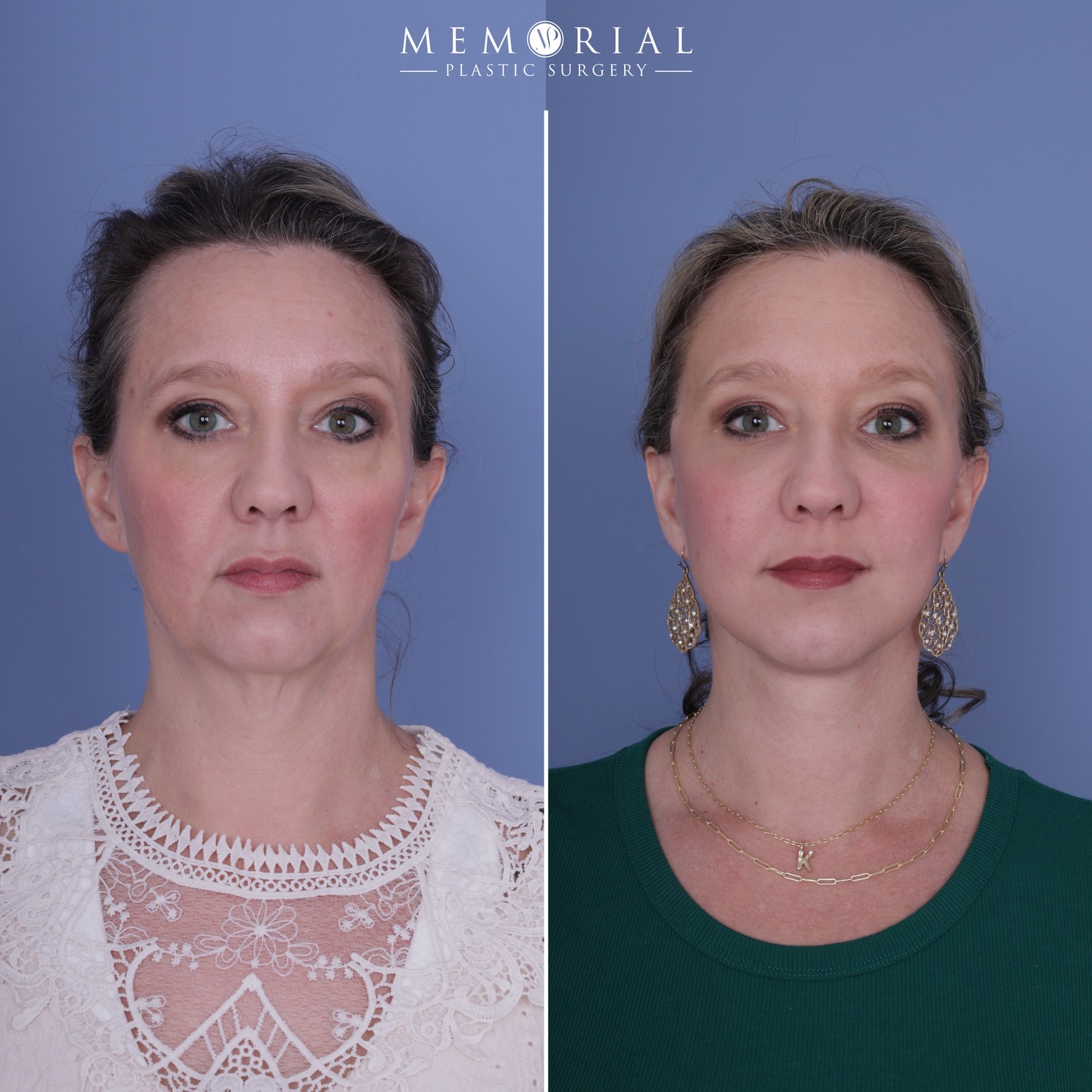 Find a dictionary, because we’ve got definition.
We’re ☝🏻 month out from a comprehensive facial rejuvenation. Still some swelling going down and incision maturation that’s happening as we speak, but the definition and structure is back.
This is such a great example of how the soft tissue of the face droops down and obscures the definition of the underlying structures of the face and neck, and how well a comprehensive tailored plan can bring that definition back.
Procedures performed:
🔹 Preservation deep plane facelift
🔹 Deep structural neck lift with gland contouring
🔹 Temporal brow lift
🔹 Lower lid blepharoplasty
🔹 Facial fat grafting
As always, hit me with questions or comments below 💬