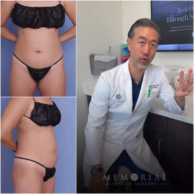 Beautiful, natural 4 month post-op result 🤩
Procedure: Lipo360 w/ High Def & J-Plasma to abdomen, Lipo to inner thighs
(Pre-Sx Wt: 121 lbs Ht: 5’1 BMI: 22.9)
#beforeandafter #houstontx #plasticsurgery @memorialplasticsurgery
