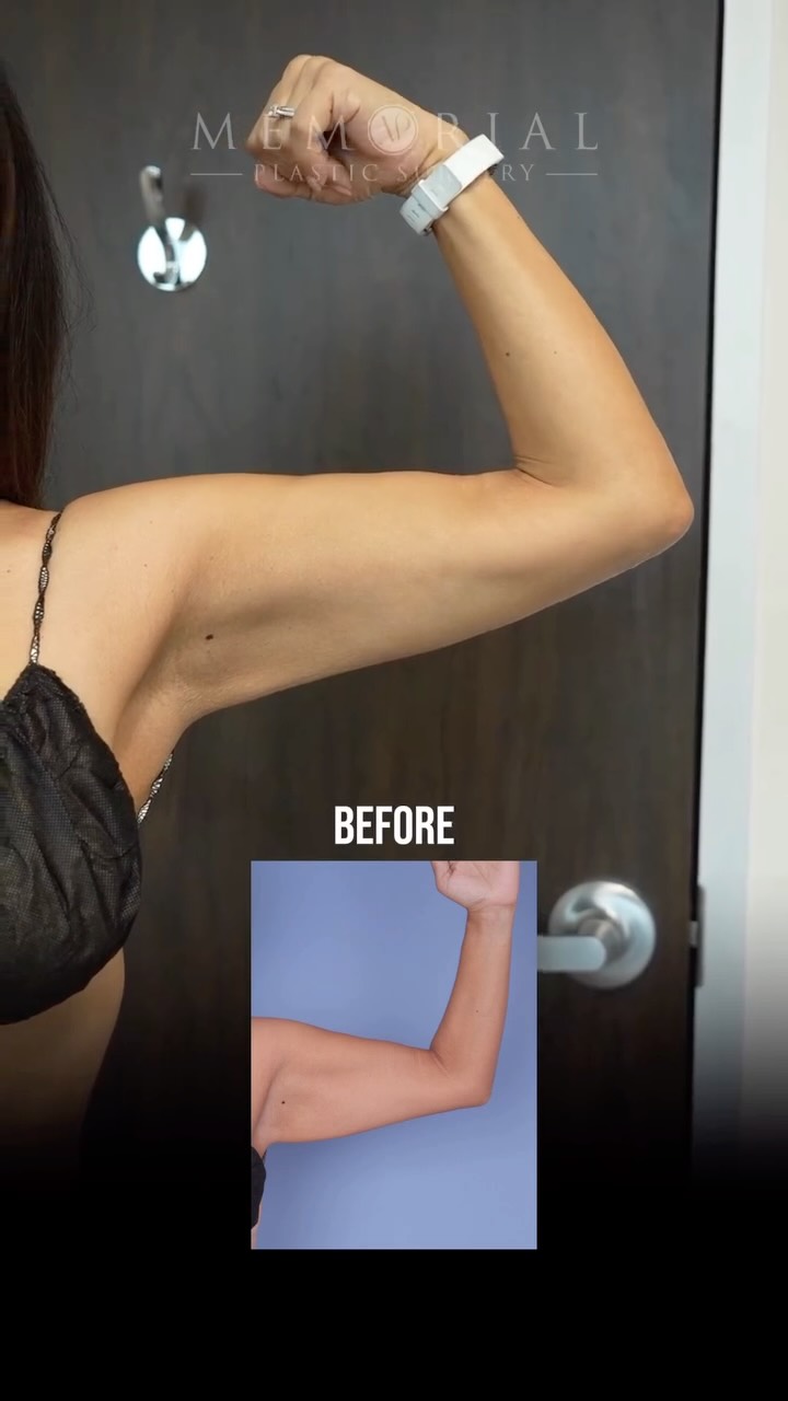 Body contouring doesn’t stop at the torso 💪🏼
Stubborn fat in the upper arms can impact the final silhouette just as much as the abdomen. 👆🏼
Procedure: Lipo to Arms
📍@memorialplasticsurgery | #Houston
#Beforeandafter #B&A #PlasticSurgery #texas