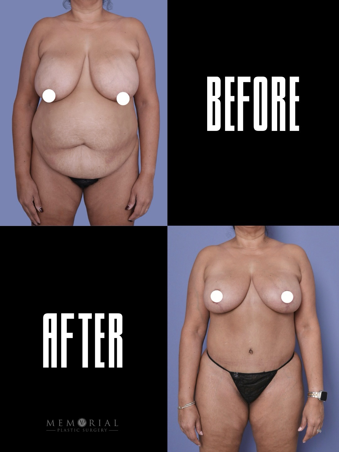 A beautiful, life-changing transformation after a 45-lb weight loss 🤩
This patient was ready for the next step in her journey, and we approached her transformation in two stages. Her procedures included an extended tummy tuck with Liposuction 360 and a breast reduction to restore balance and contour.
The goal was a flat abdomen, natural belly button, low well-healed scar, and breasts that look natural and proportionate to her body.
Now she can exercise comfortably, wear clothes with confidence, and even enjoy a two-piece bikini again. Seeing patients regain that confidence is always the best part.
Weight: 186 lbs / Height: 5’6” / BMI: 30.0
#mommymakeover #transformation #weighlossjourney #bodytransformation #houstonplasticsurgeon
📍 Memorial Plastic Surgery | houston