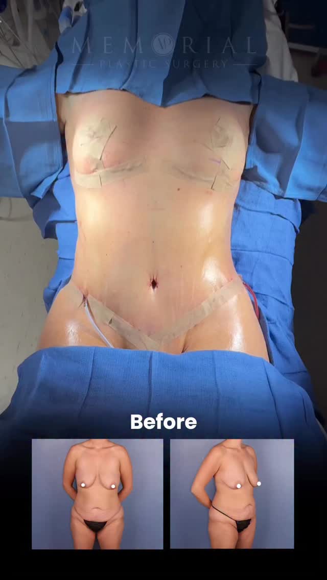 2 kids later… and feeling like herself again ✨
A beautiful #MommyMakeover transformation.
Procedure: BBL • Lipo 360 • Tummy Tuck • Breast Lift
(Pre Sx Wt: 153 lbs Ht: 5’6 BMI: 24.7)
📍 @memorialplasticsurgery | #Houston
