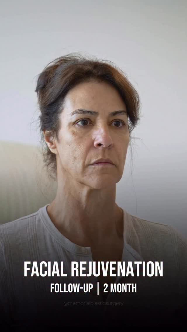 62 years young.
We’re not even two months out from a comprehensive facial rejuvenation, and you can already see the difference that restoring structure and balance can make. There’s still a little healing happening behind the scenes this early on, but the refreshed contour of the jawline, neck, and midface is already shining through.
This is what happens when careful planning meets meticulous execution. The result still looks like you… but younger and full of energy.
Procedure(s) performed:�🔹 Preservation deep plane facelift
🔹 Deep neck lift with gland contouring
🔹 Brow lift
🔹 Lower lid blepharoplasty
🔹 Fat grafting
As always, feel free to drop any questions below. 💬