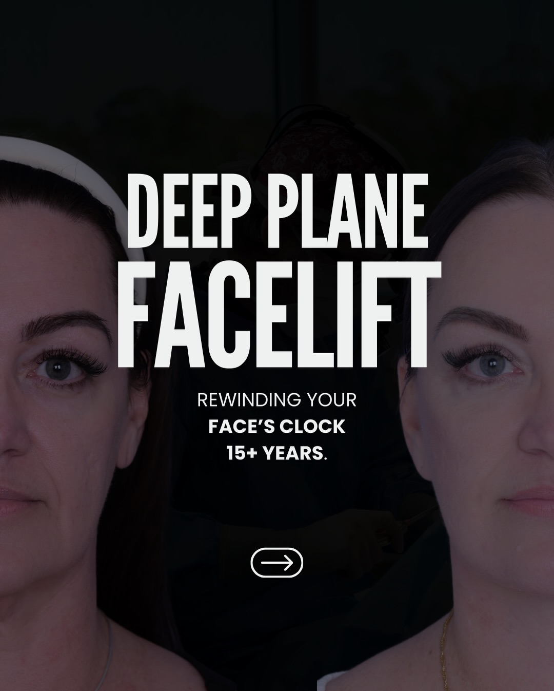 Gravity always wins. When things fall down, the only thing that works is to lift them back up. It’s important to lift the right things back up: the stronger layers of the face instead of just pulling on the skin.
A deep plane facelift is how we turn the clock back 15 years, and still keep you looking like you
Answering any and all questions & comments below 💬
📍@memorialplasticsurgery | #Houston