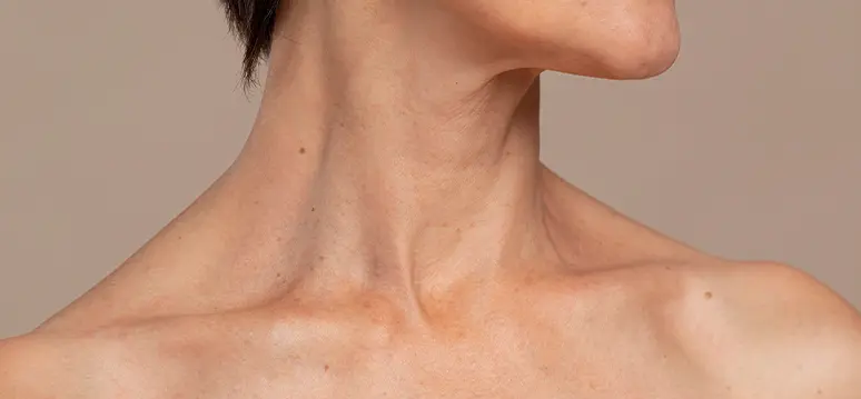 Woman showing sagging skin and loose neck area associated with turkey neck