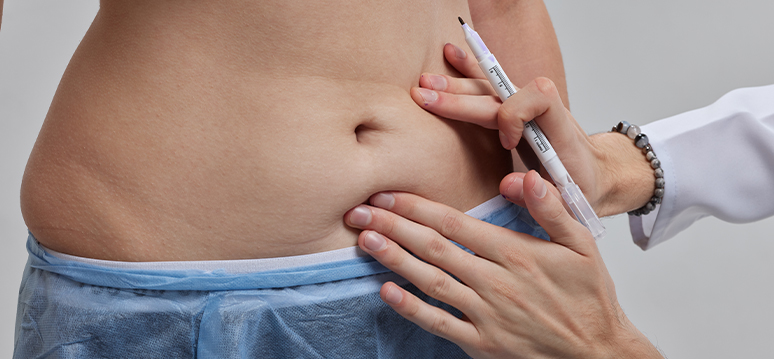 Liposuction Near Me