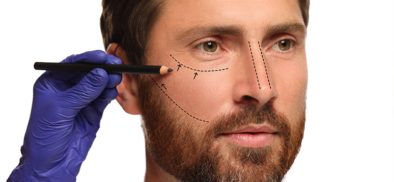 Male Facelift